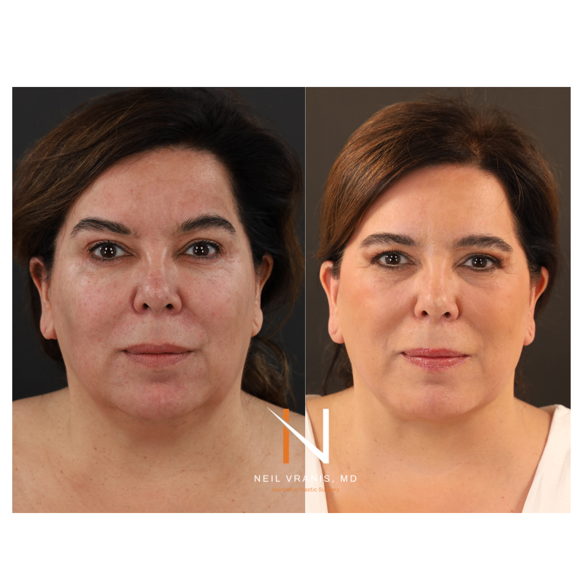 Dr. Neil Vranis Facial Contouring Before and After Picture