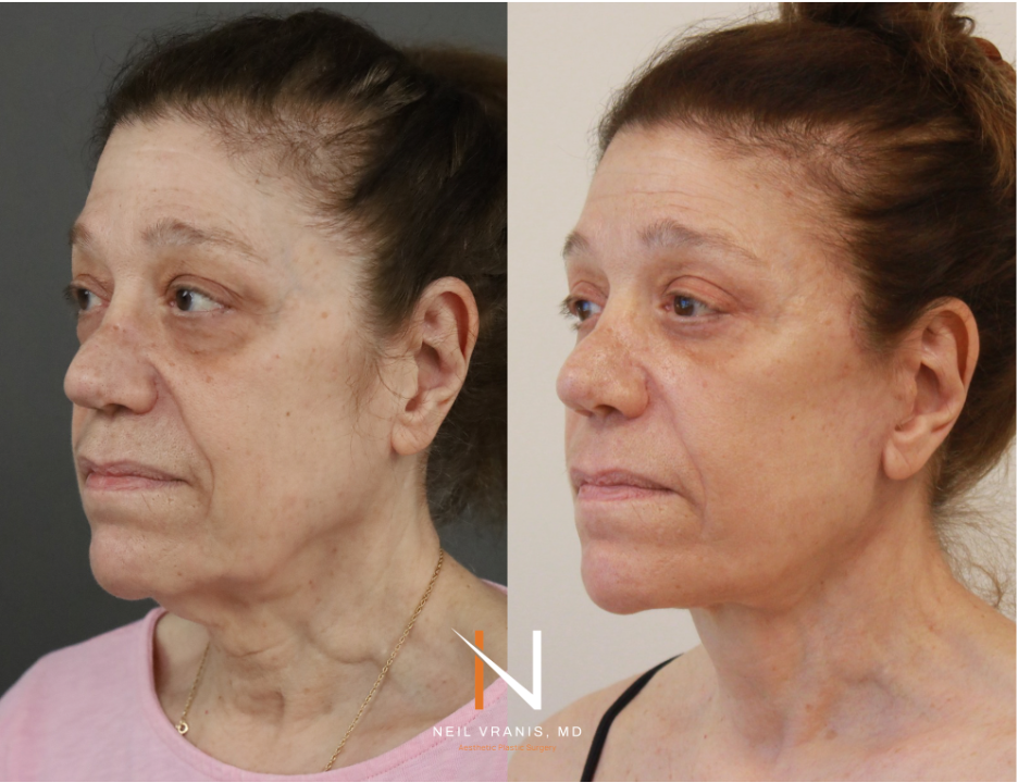 Dr. Neil Vranis Facial Contouring Before and After Picture