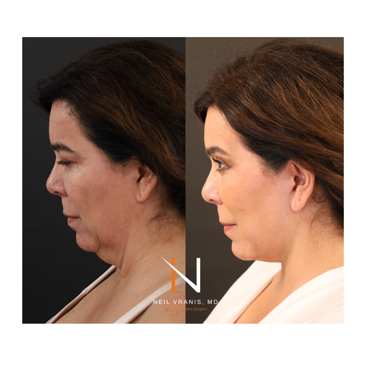Dr. Neil Vranis Facial Contouring Before and After Picture
