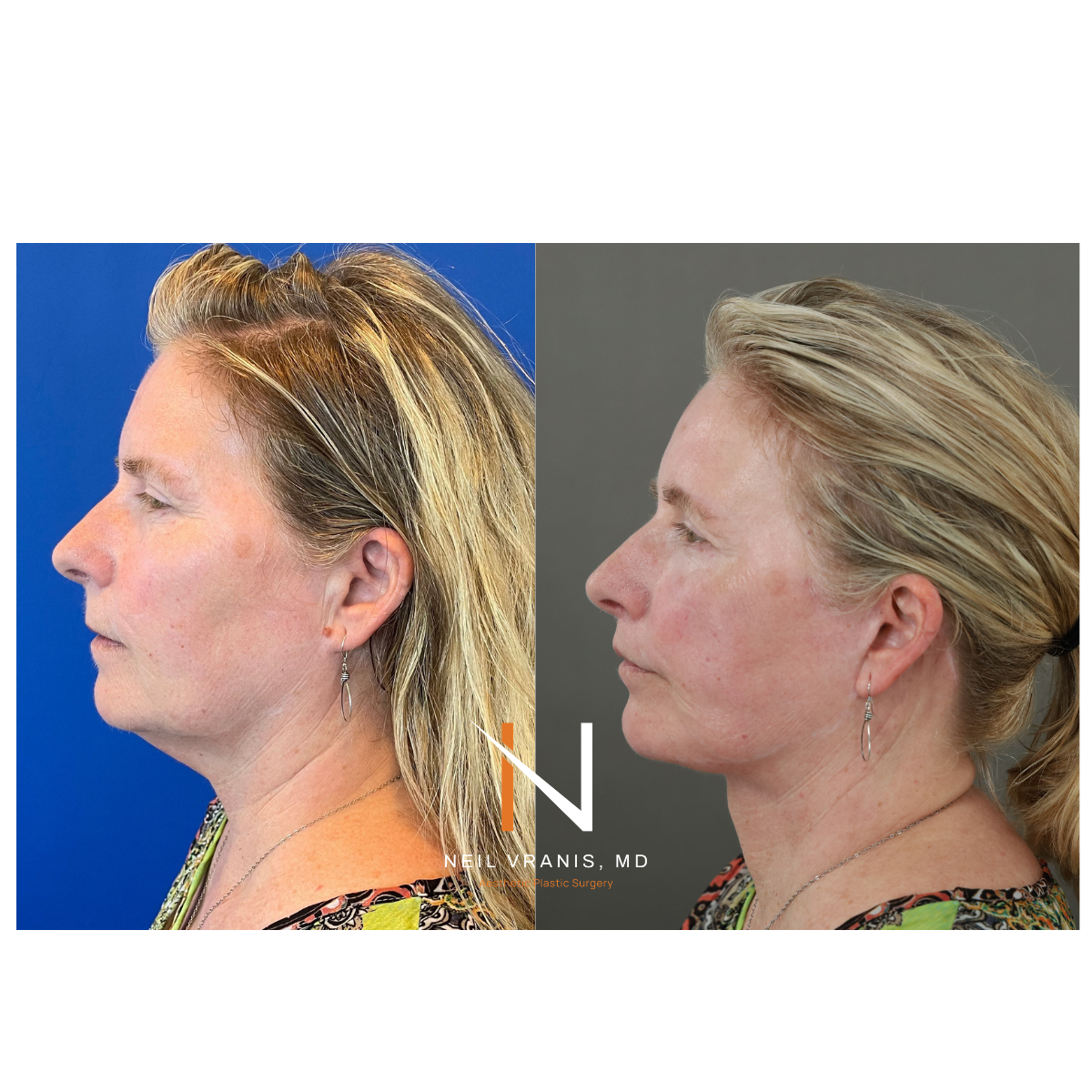 Dr. Neil Vranis Facial Contouring Before and After Picture