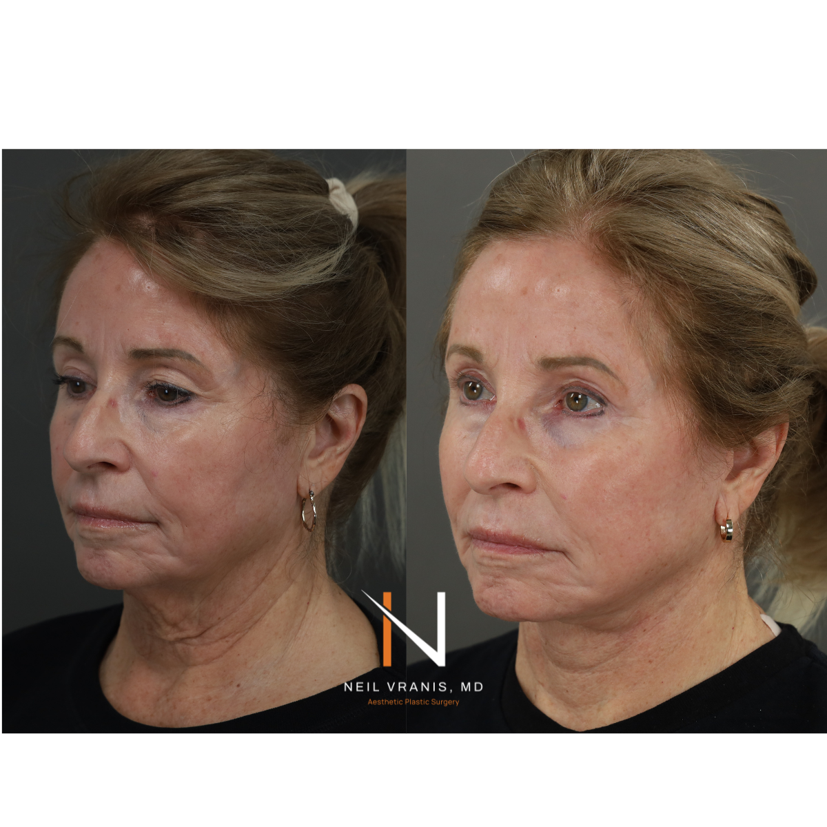 Dr. Neil Vranis Facial Contouring Before and After Picture