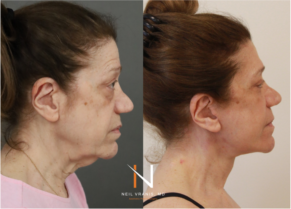 Dr. Neil Vranis Facial Contouring Before and After Picture