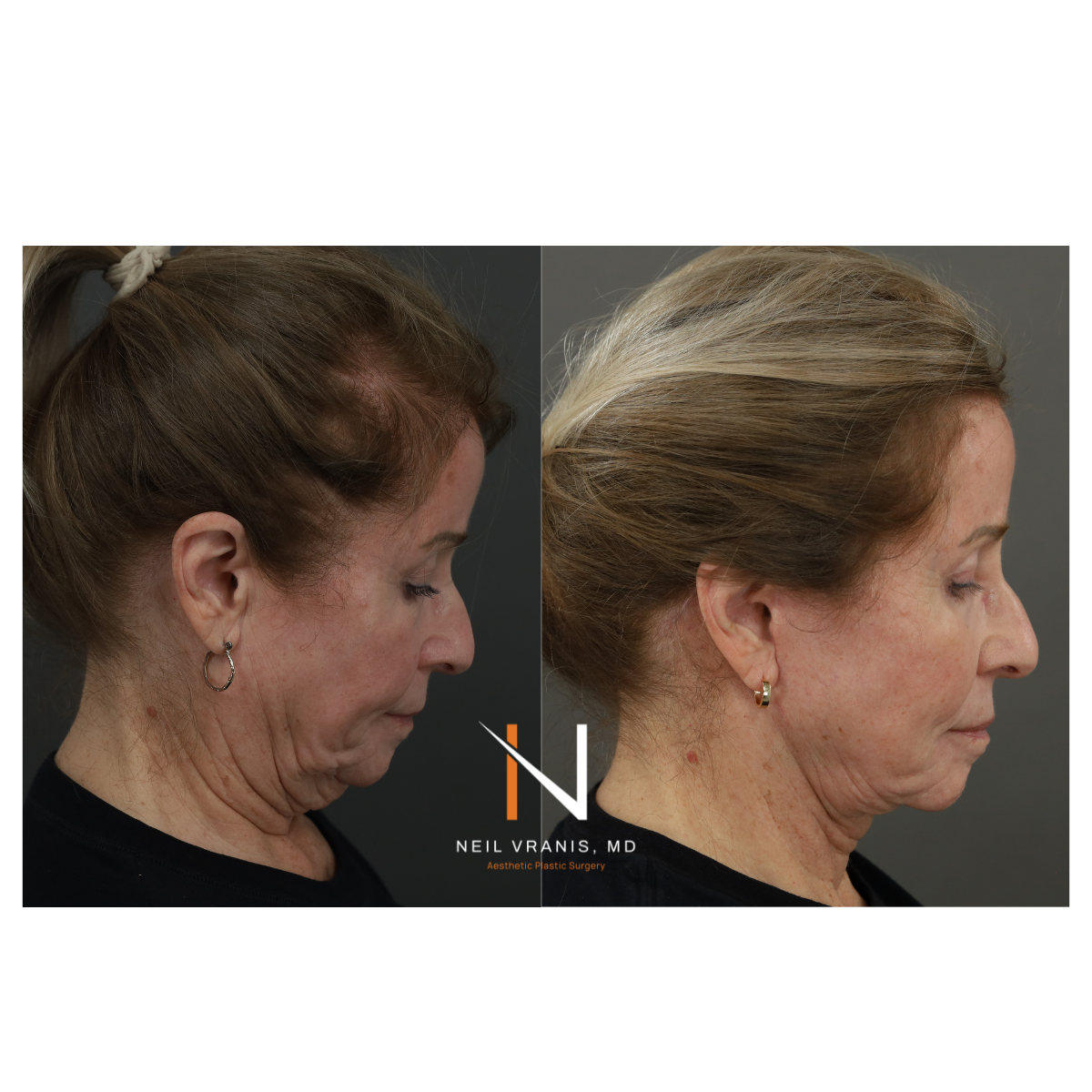 Dr. Neil Vranis Facial Contouring Before and After Picture