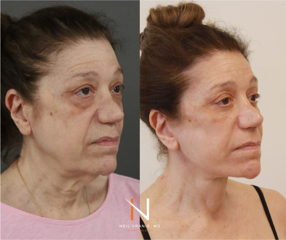 Dr. Neil Vranis Facial Contouring Before and After Picture