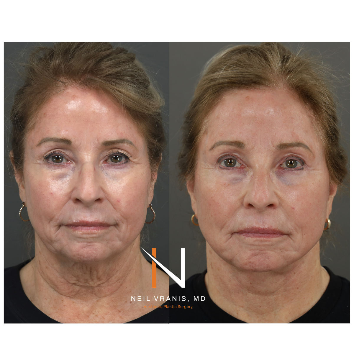 Dr. Neil Vranis Facial Contouring Before and After Picture