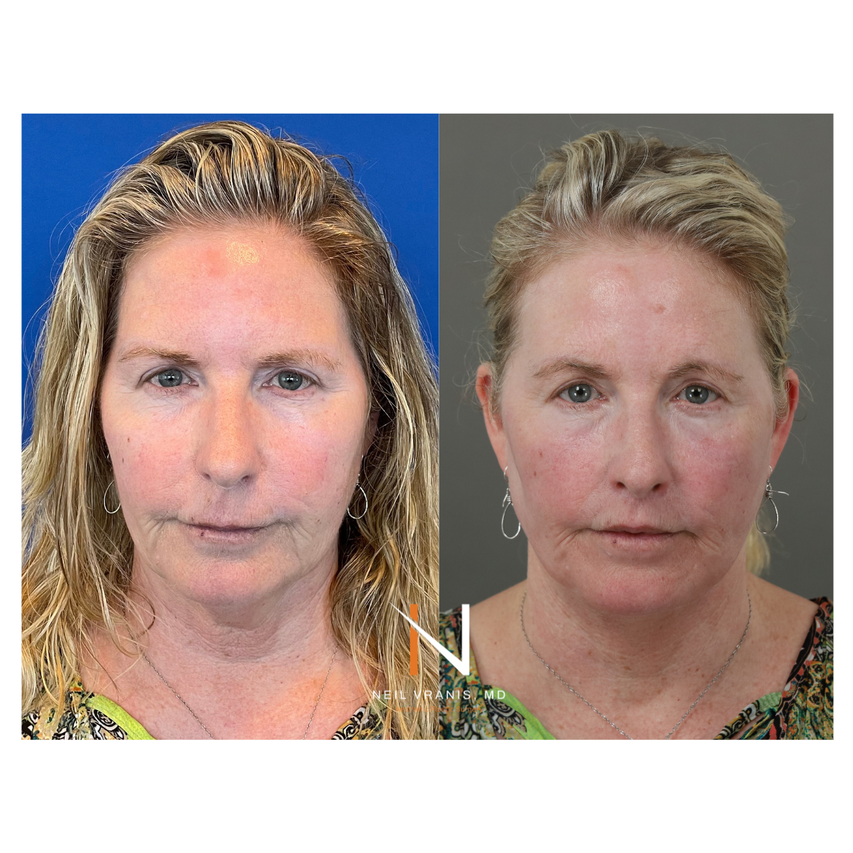 Dr. Neil Vranis Facial Contouring Before and After Picture