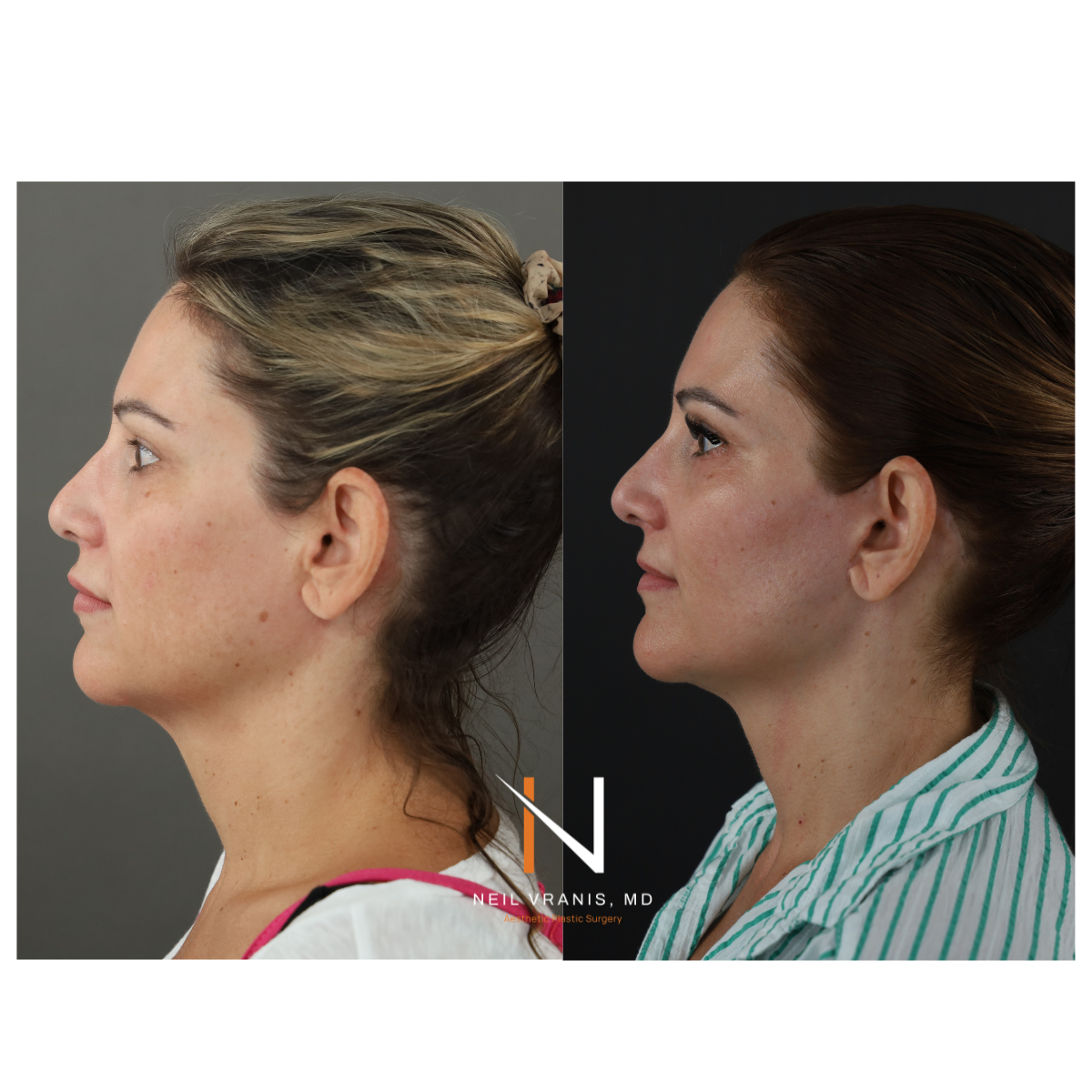Dr. Neil Vranis Facial Contouring Before and After Picture
