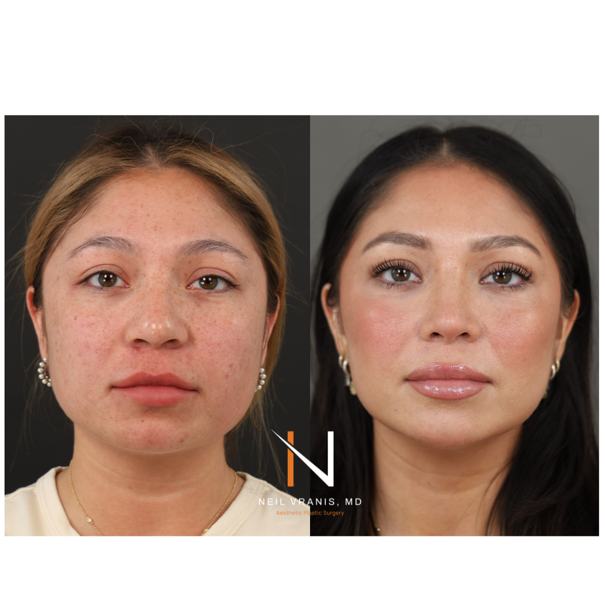 Dr. Neil Vranis Before and After Picture