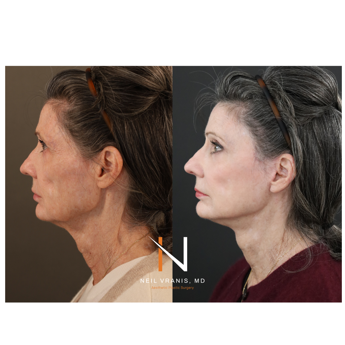 Dr. Neil Vranis Before and After Picture