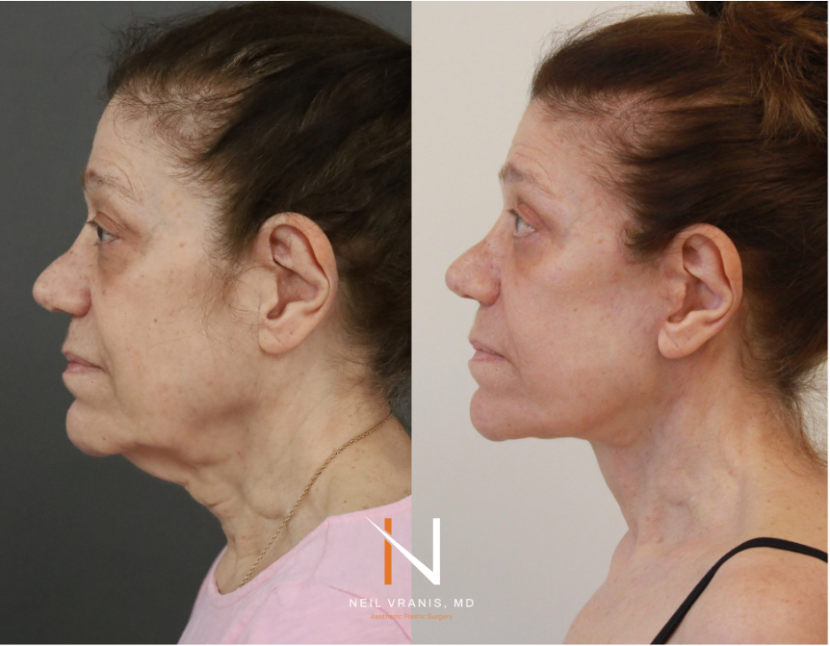 Dr. Neil Vranis Before and After Picture