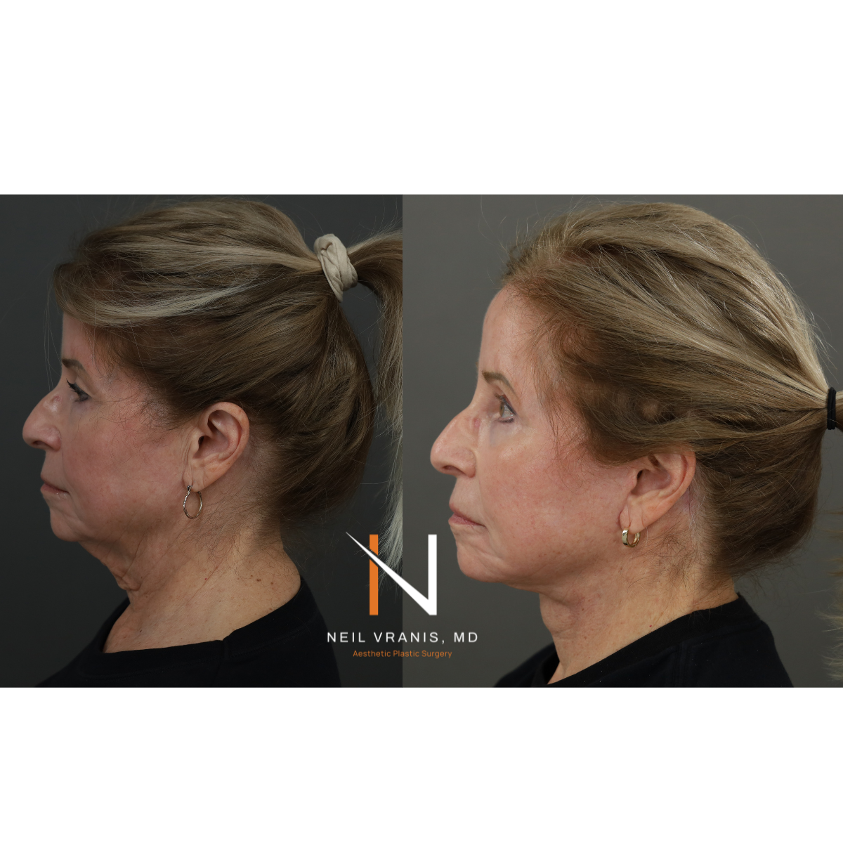 Dr. Neil Vranis Before and After Picture