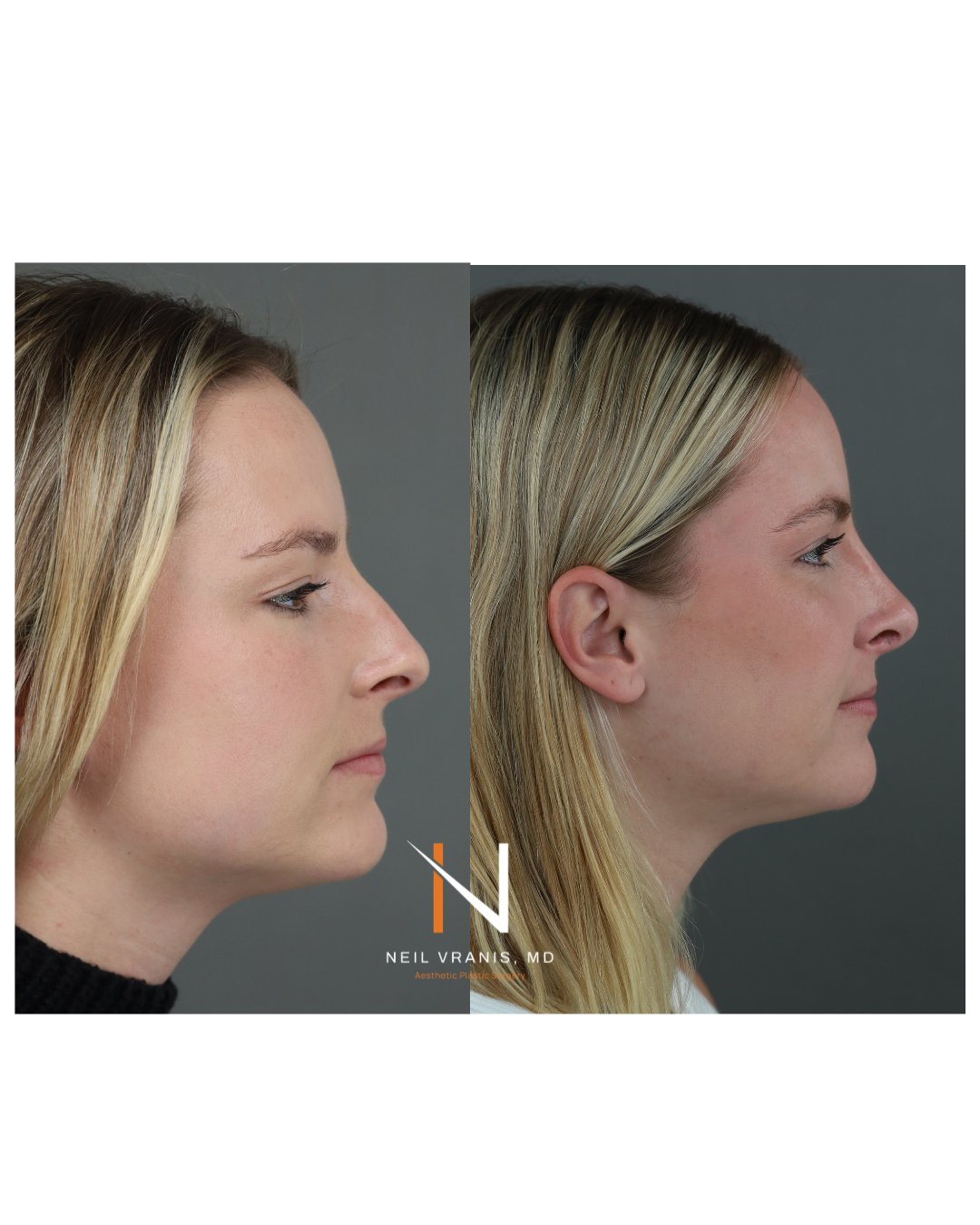 Dr. Neil Vranis Before and After Picture