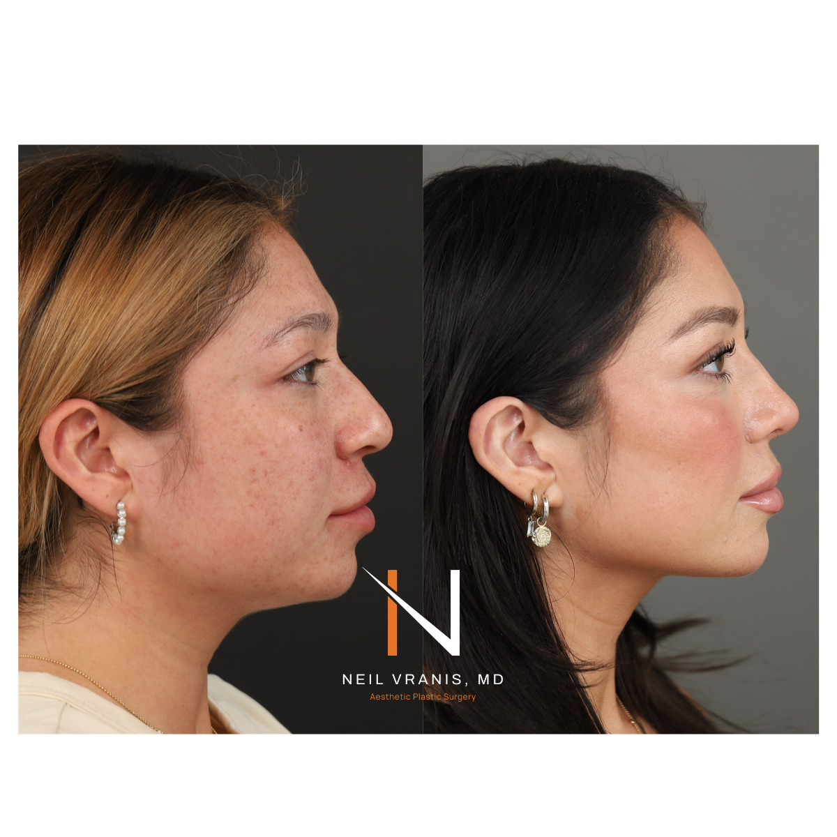 Dr. Neil Vranis Before and After Picture