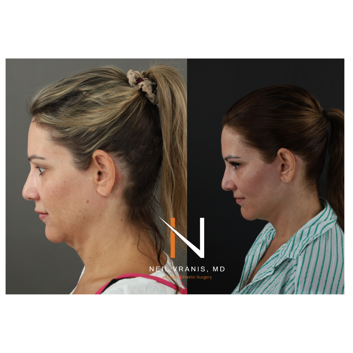 Dr. Neil Vranis Before and After Picture