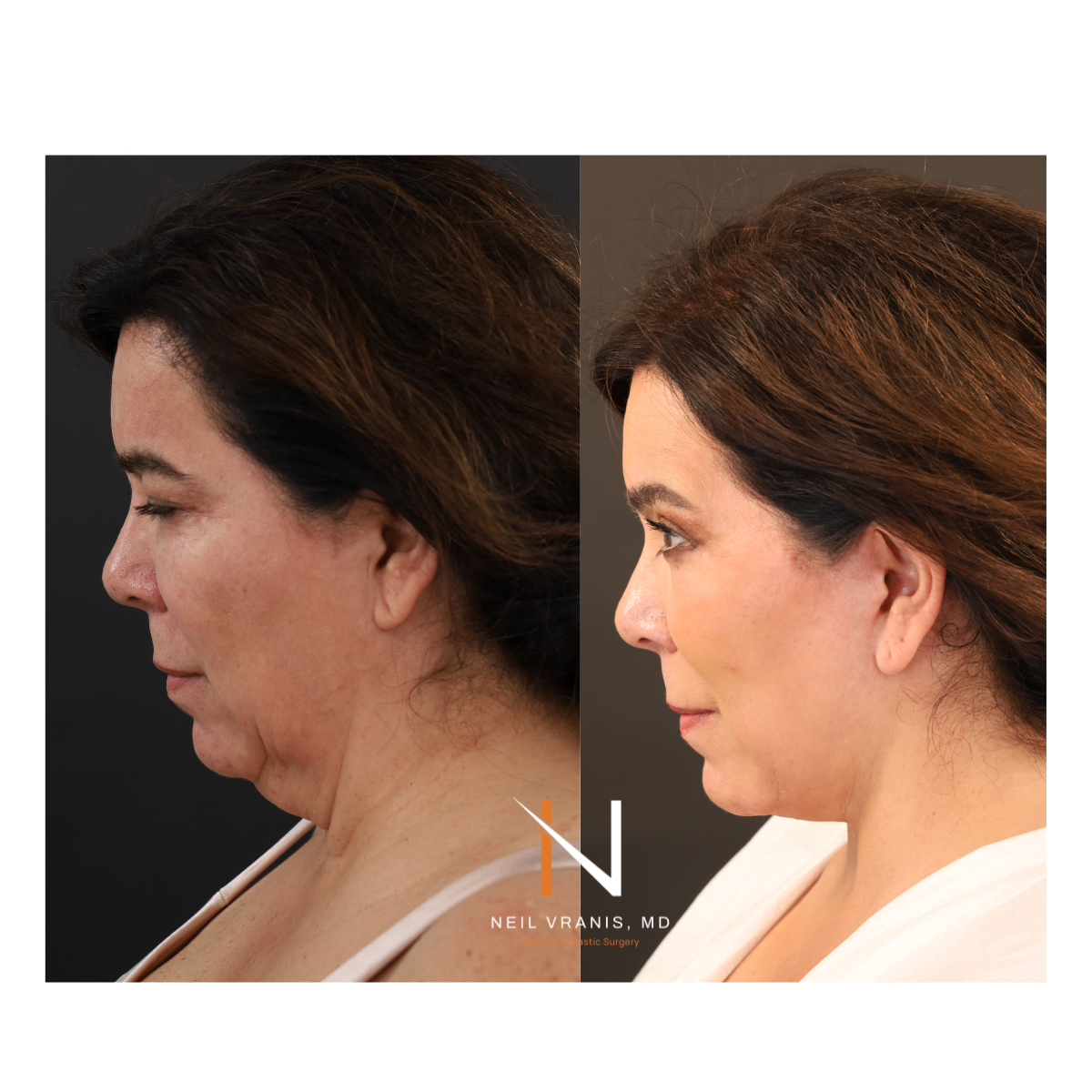 Dr. Neil Vranis Before and After Picture