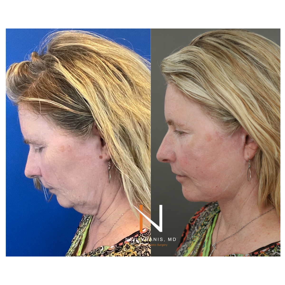 Dr. Neil Vranis Before and After Picture