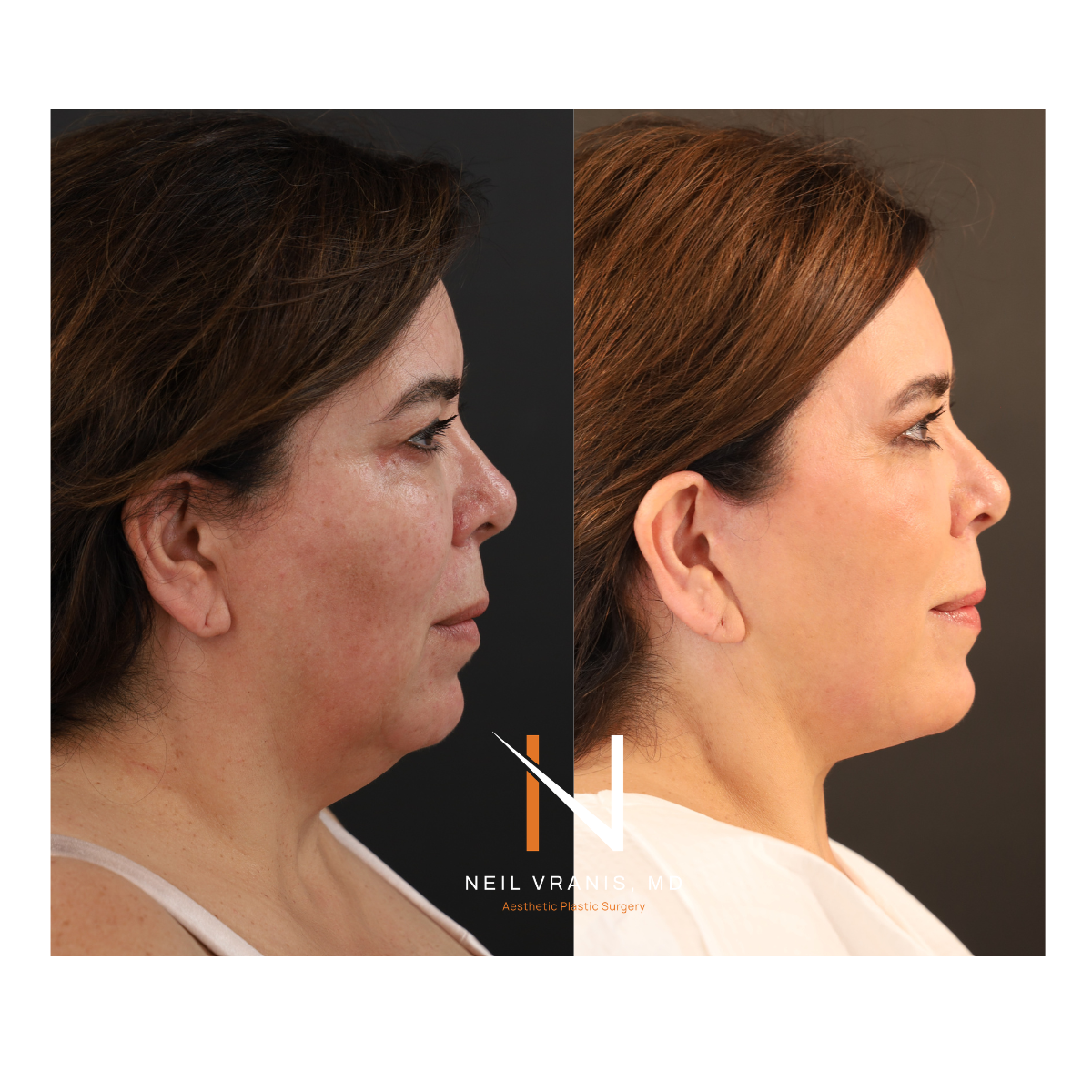 Dr. Neil Vranis Before and After Picture