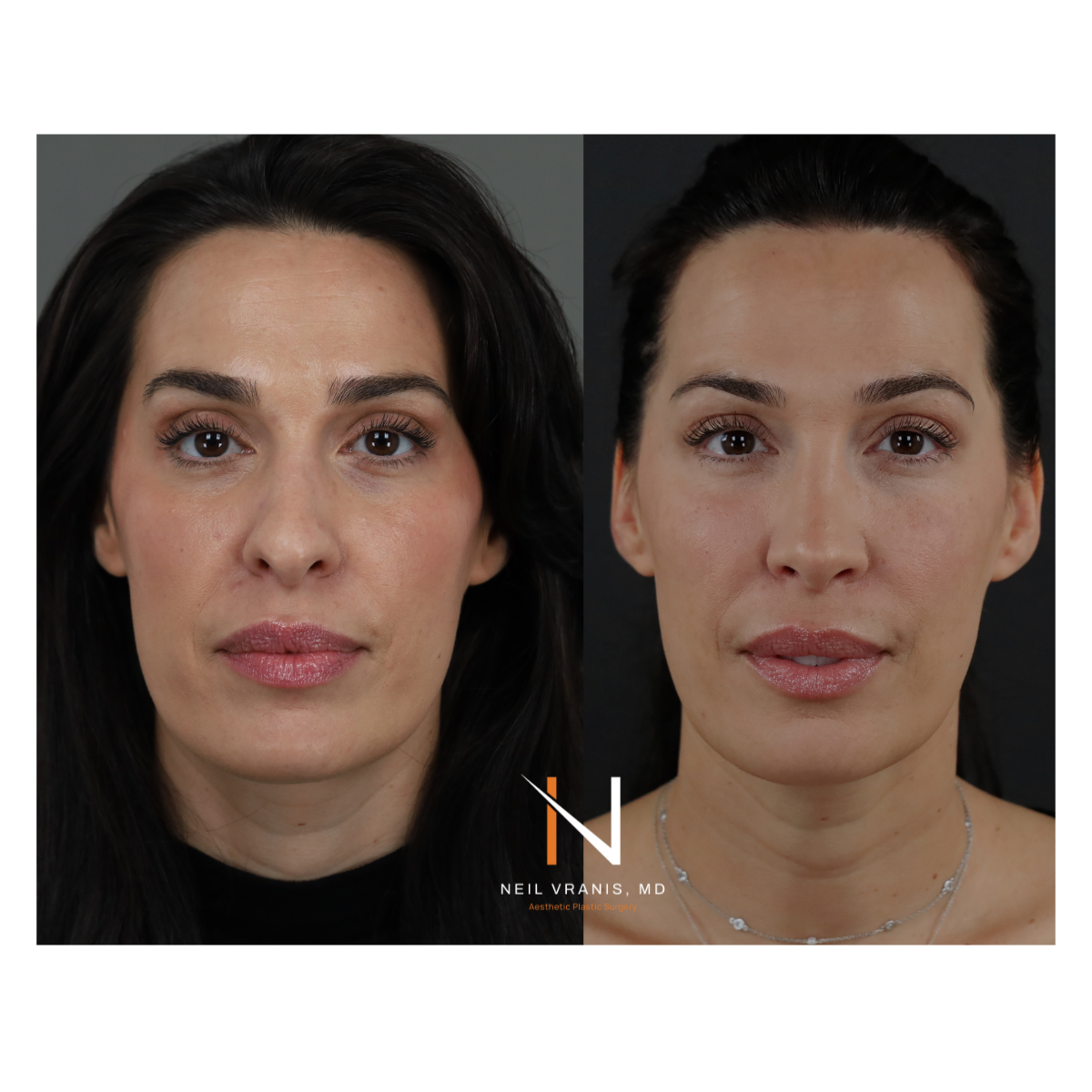 Dr. Neil Vranis Before and After Picture