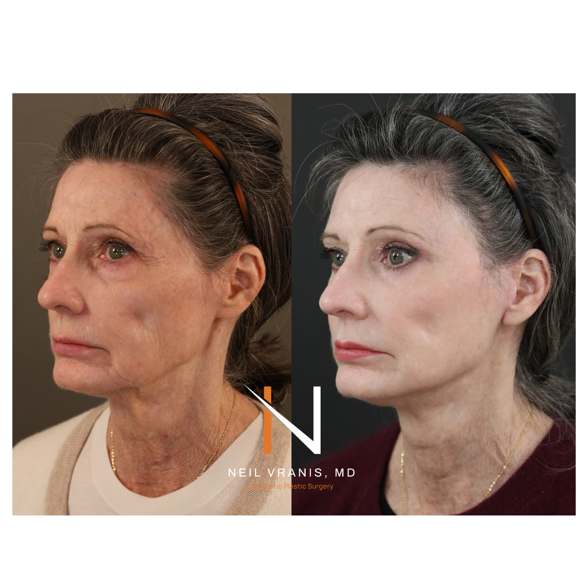Dr. Neil Vranis Before and After Picture