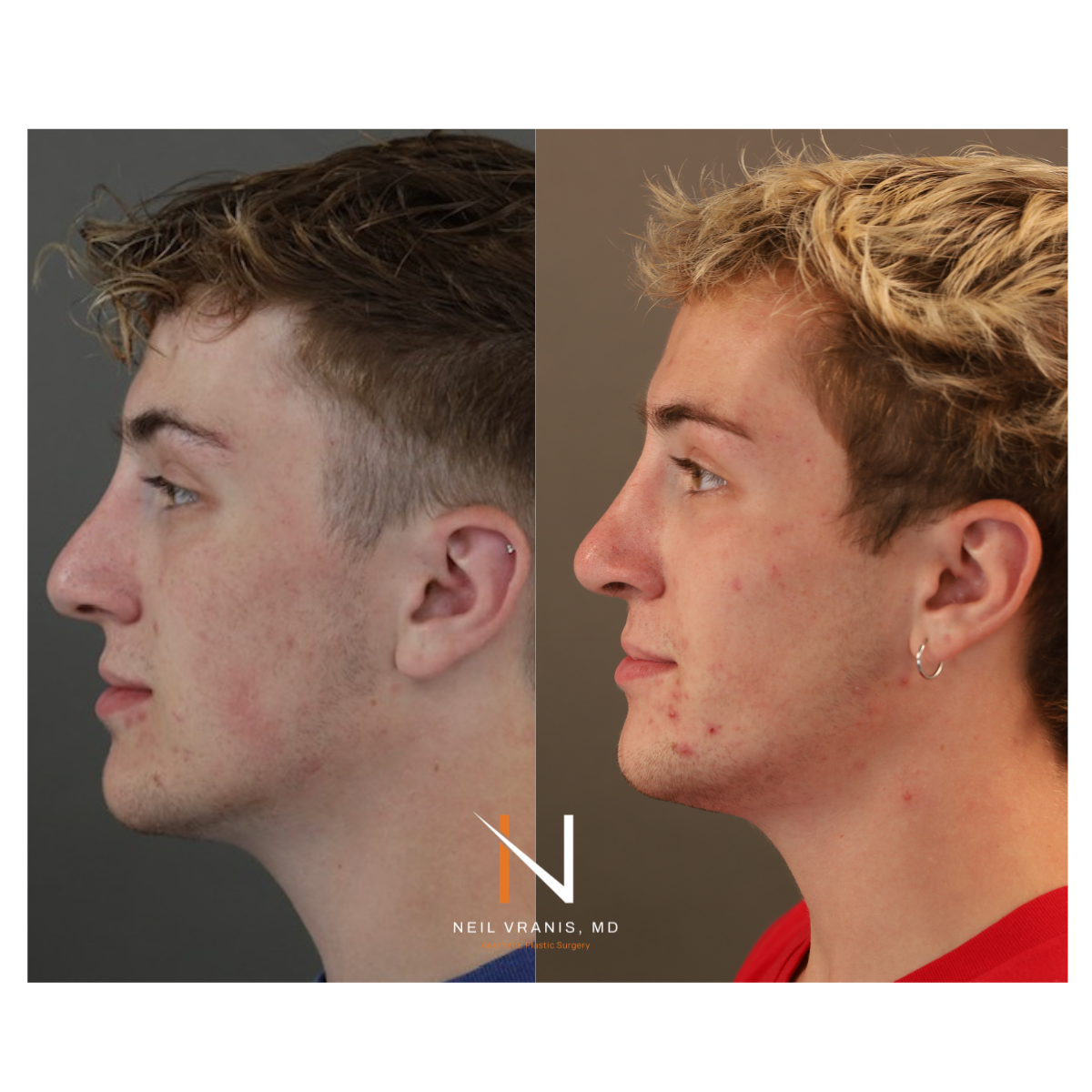 Dr. Neil Vranis Before and After Picture