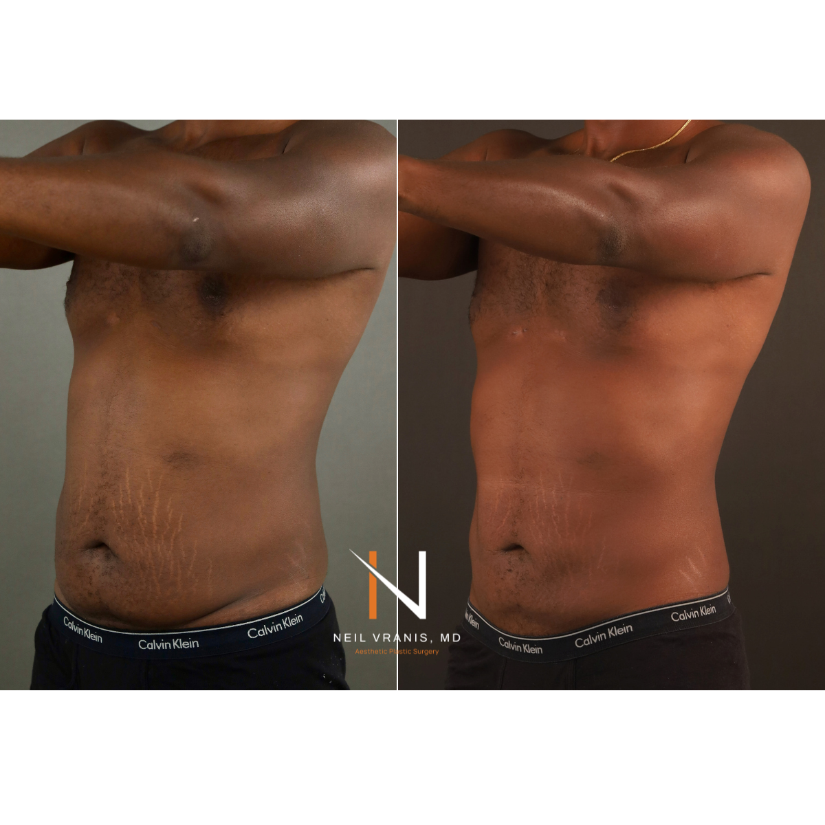 Dr. Neil Vranis Before and After Picture