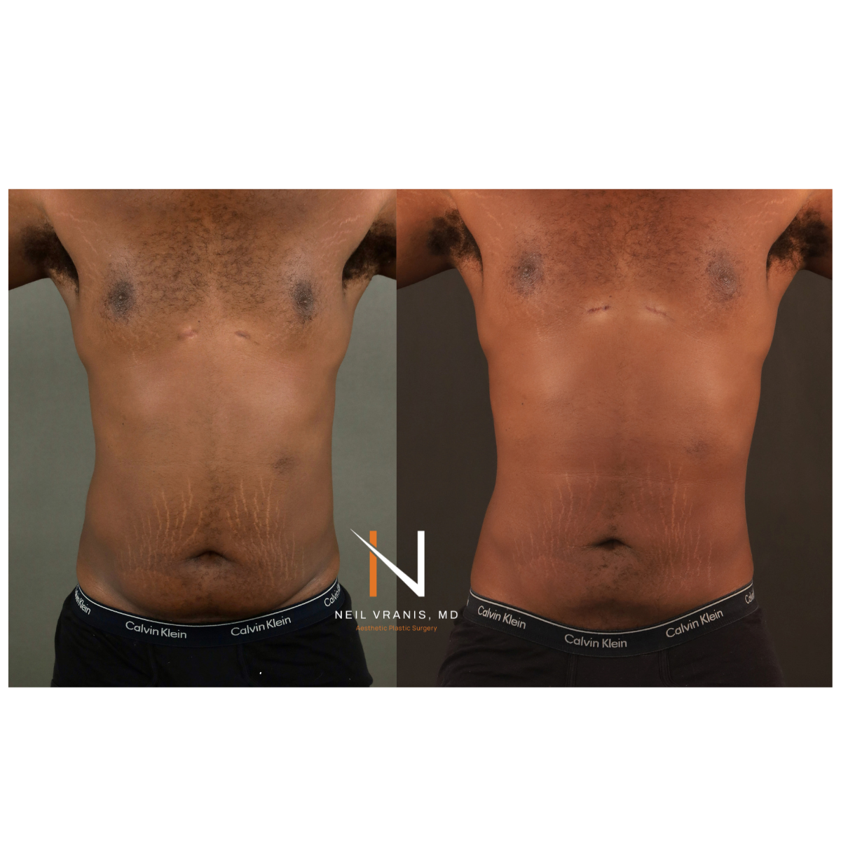 Dr. Neil Vranis Before and After Picture
