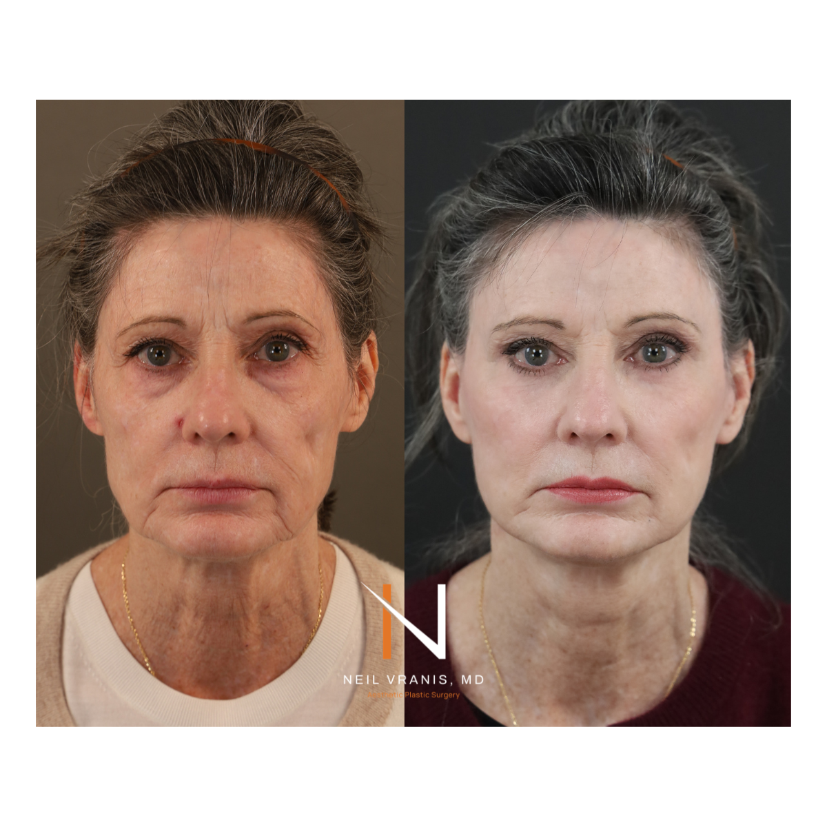 Dr. Neil Vranis Before and After Picture