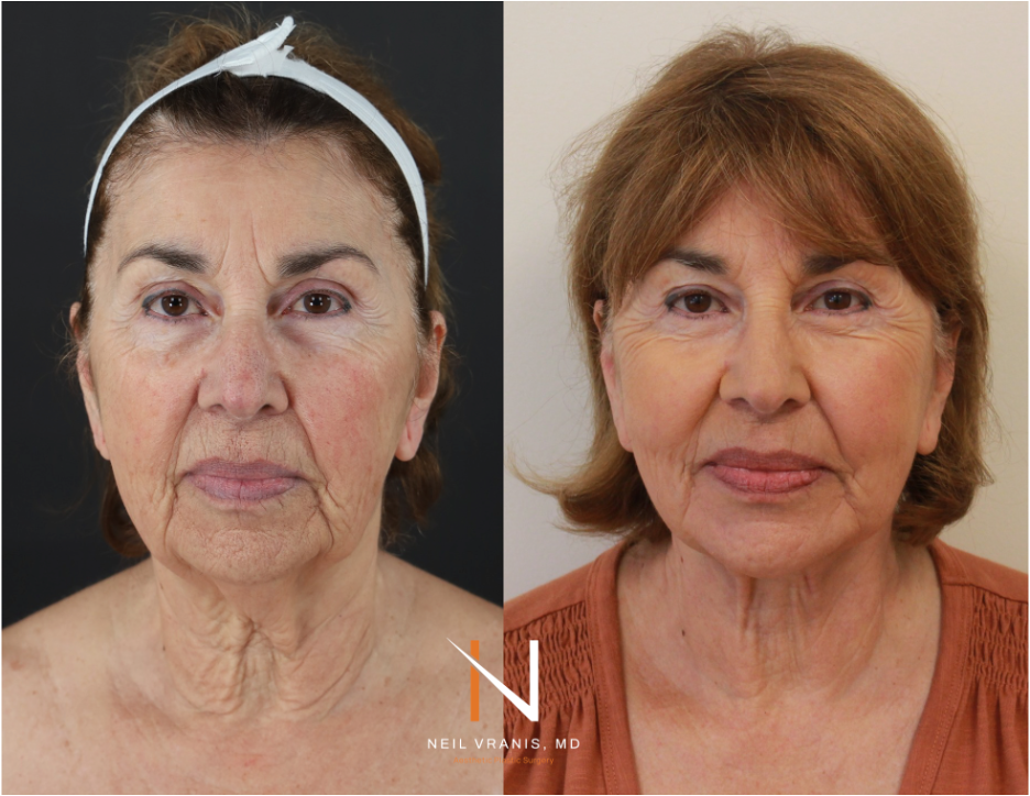 Dr. Neil Vranis Before and After Picture