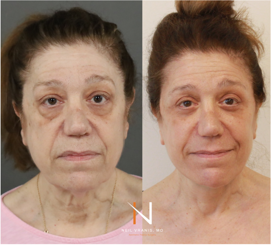 Dr. Neil Vranis Before and After Picture