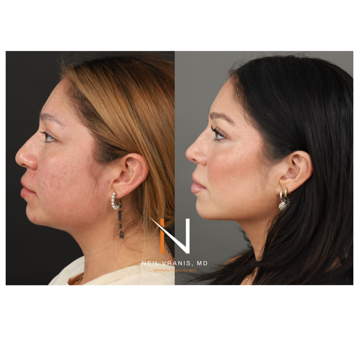 Dr. Neil Vranis Before and After Picture