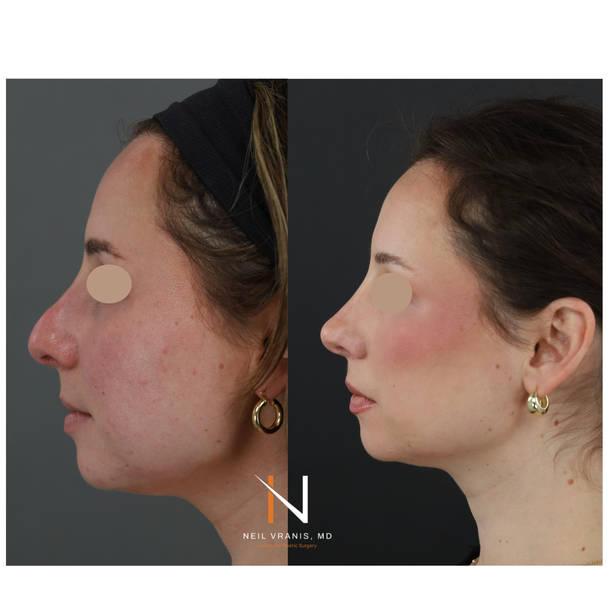 Dr. Neil Vranis Before and After Picture