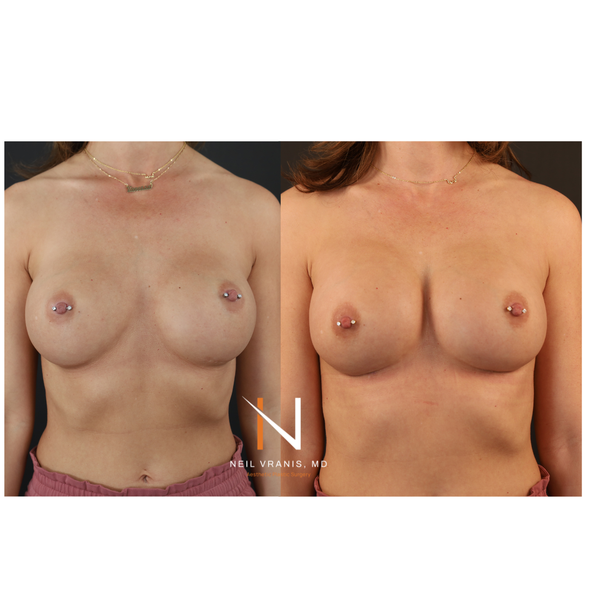 Dr. Neil Vranis Mommy Makeover Before and After Picture
