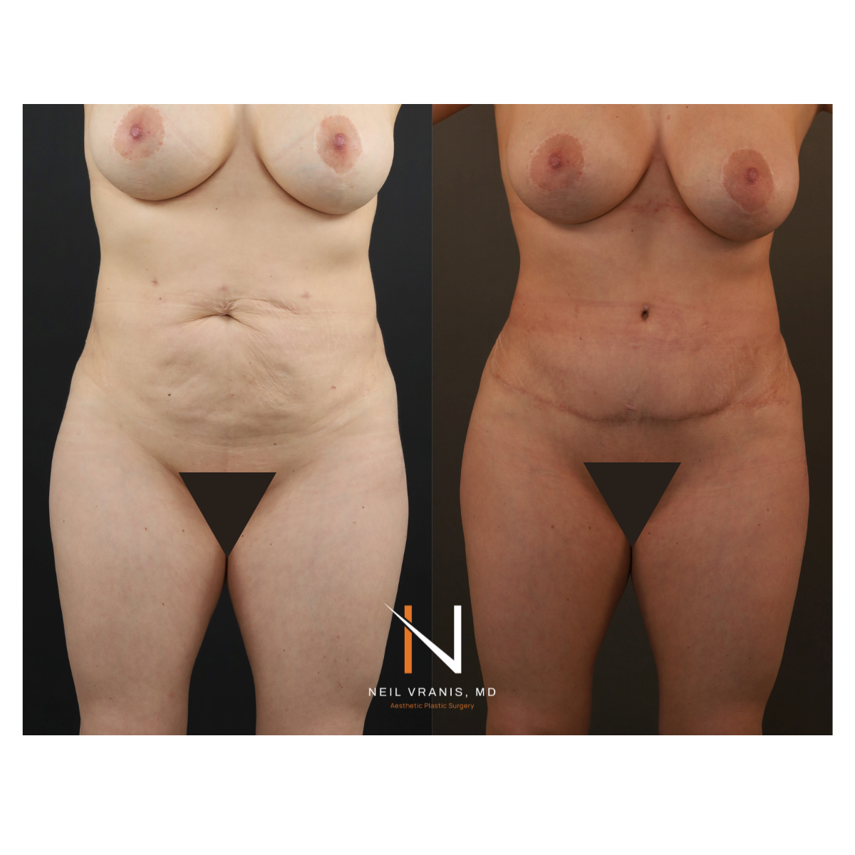 Dr. Neil Vranis Mommy Makeover Before and After Picture