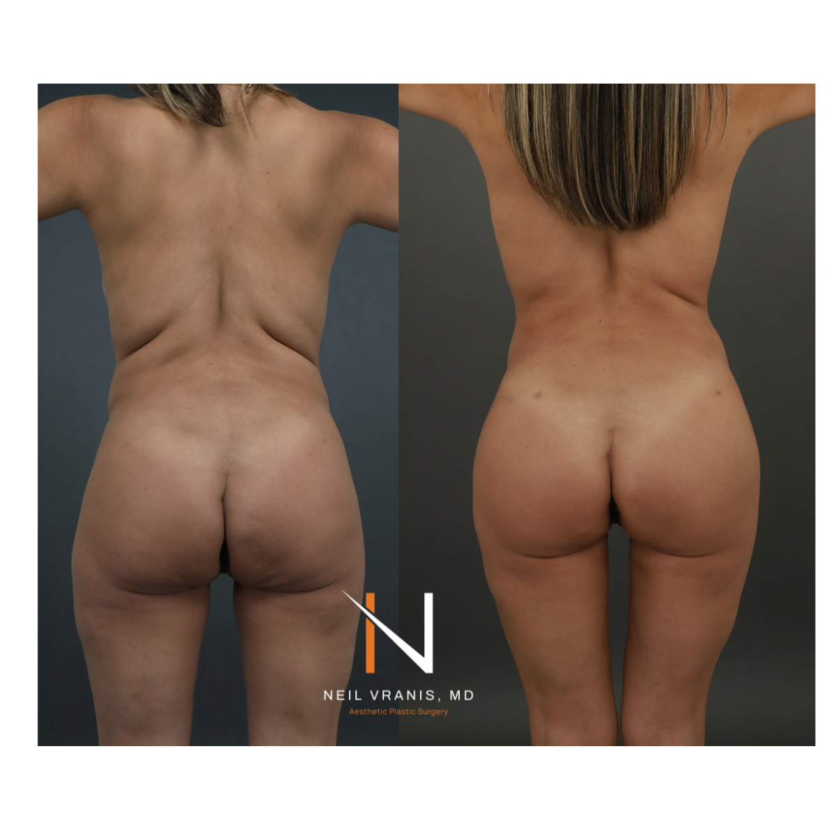 Dr. Neil Vranis Mommy Makeover Before and After Picture