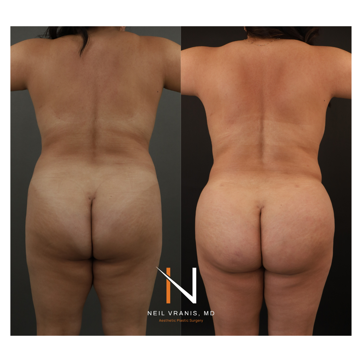 Dr. Neil Vranis Mommy Makeover Before and After Picture