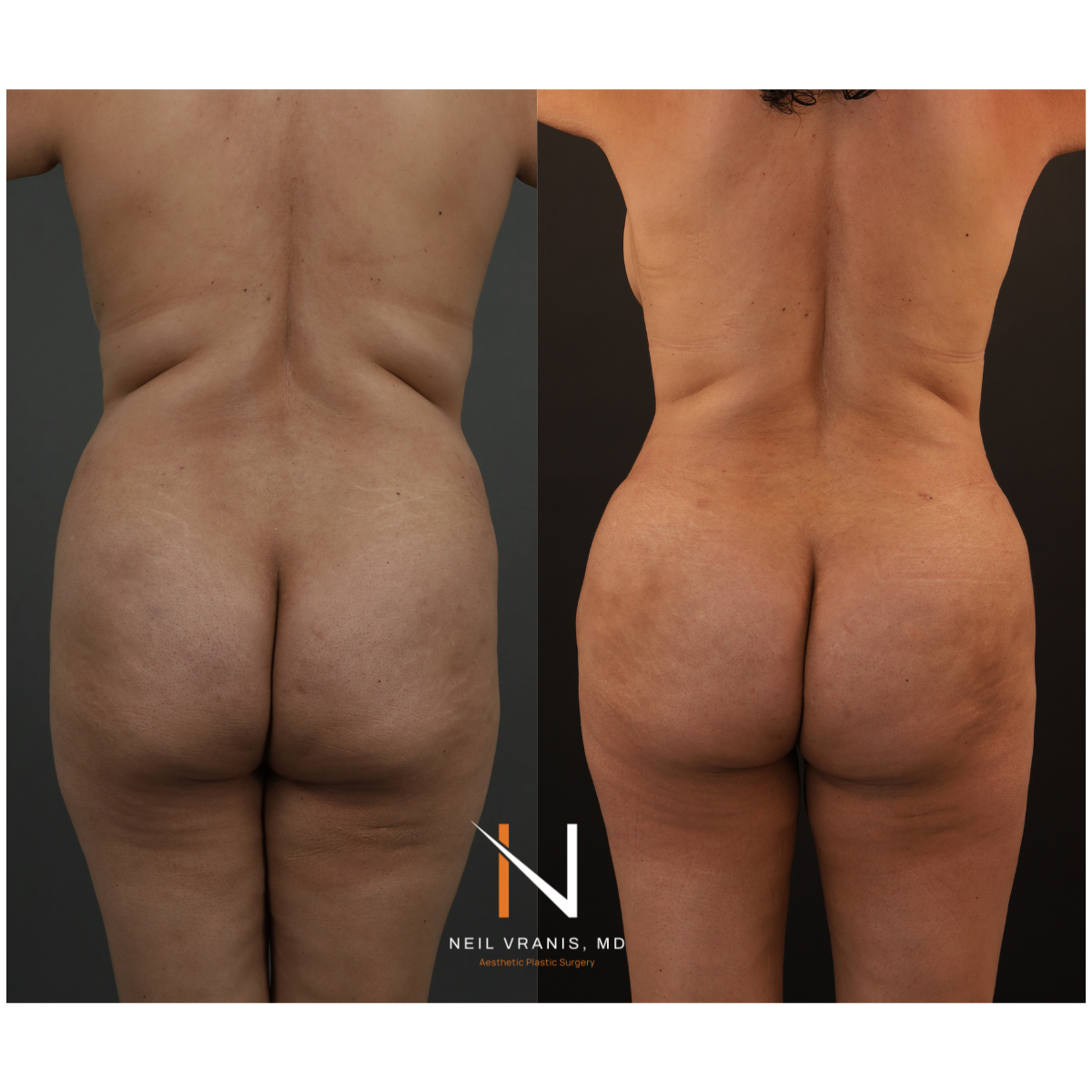 Dr. Neil Vranis Mommy Makeover Before and After Picture