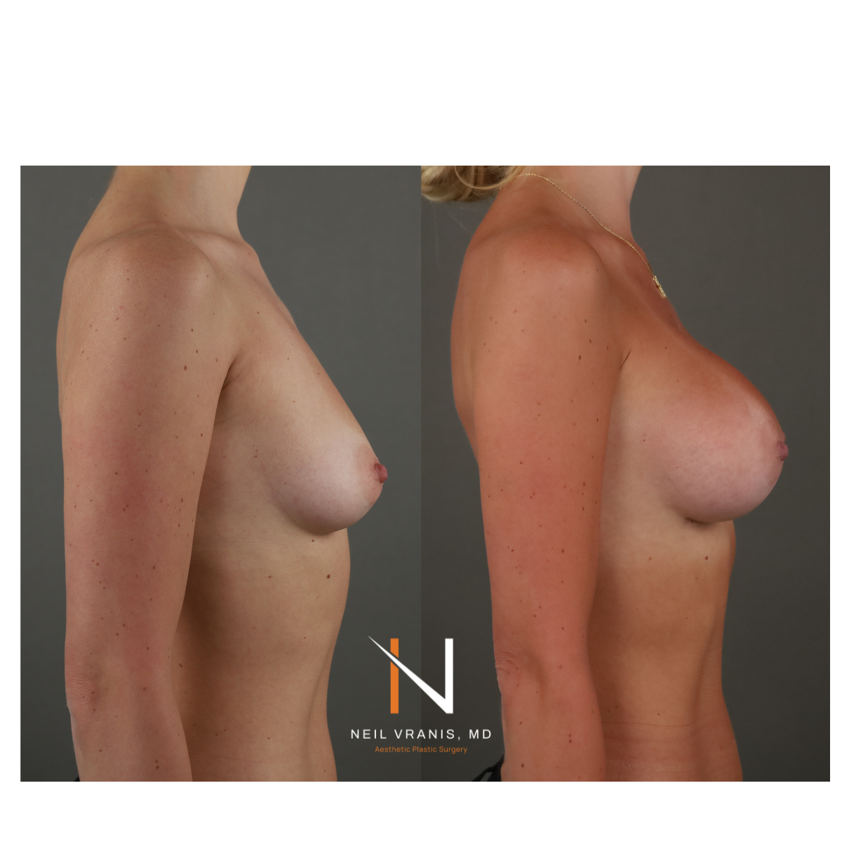 Dr. Neil Vranis Mommy Makeover Before and After Picture