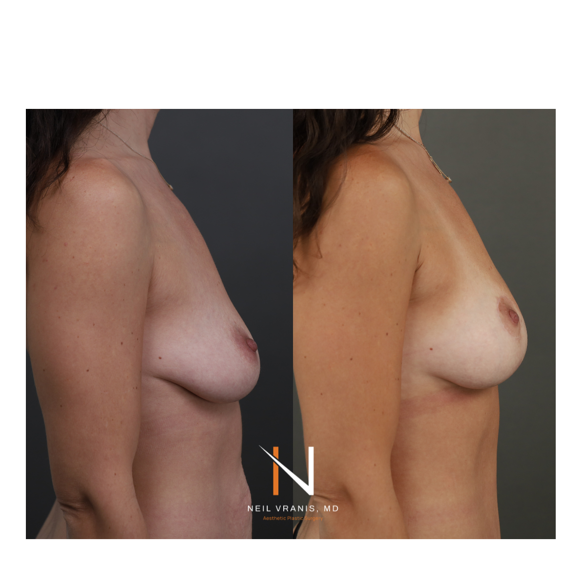 Dr. Neil Vranis Mommy Makeover Before and After Picture