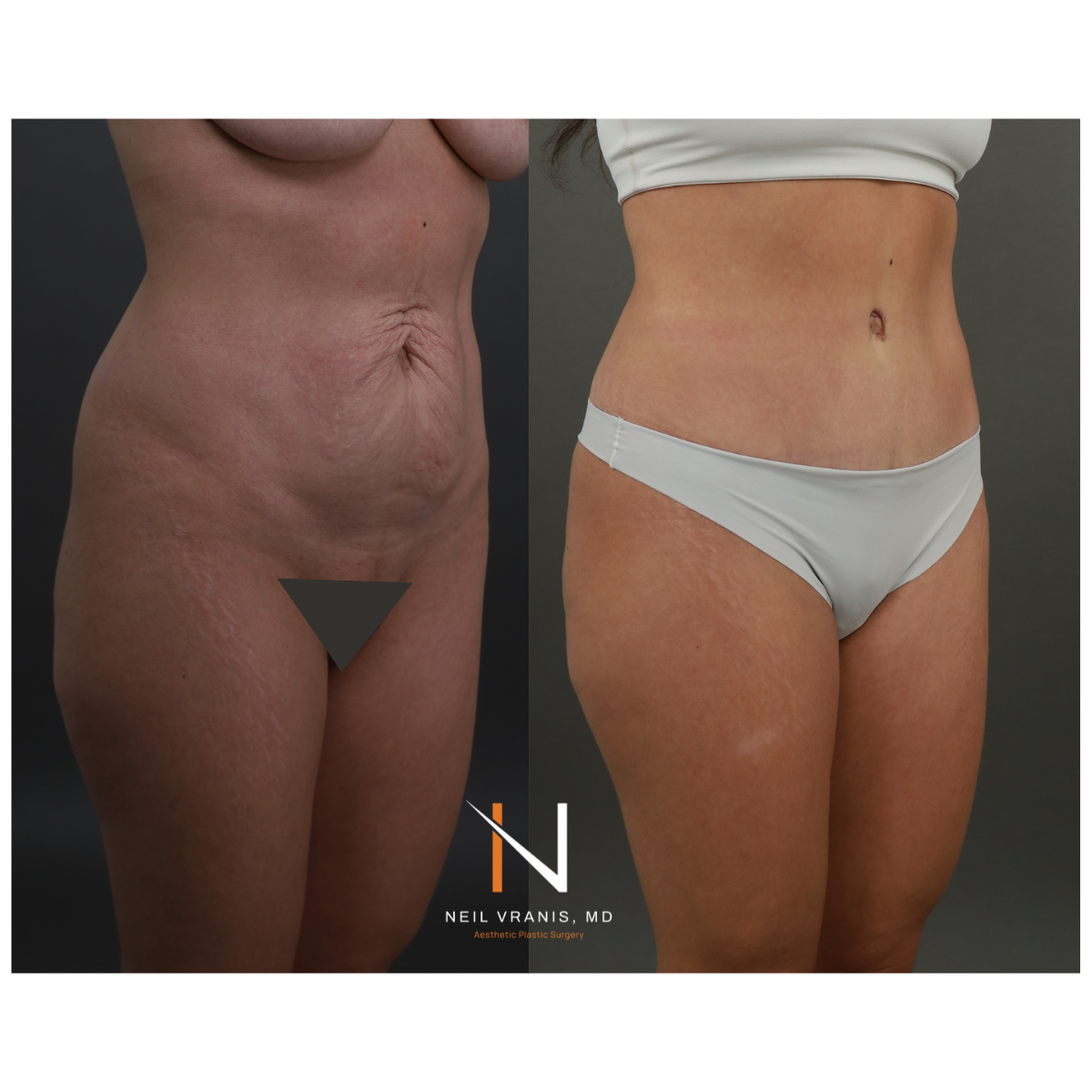 Dr. Neil Vranis Mommy Makeover Before and After Picture