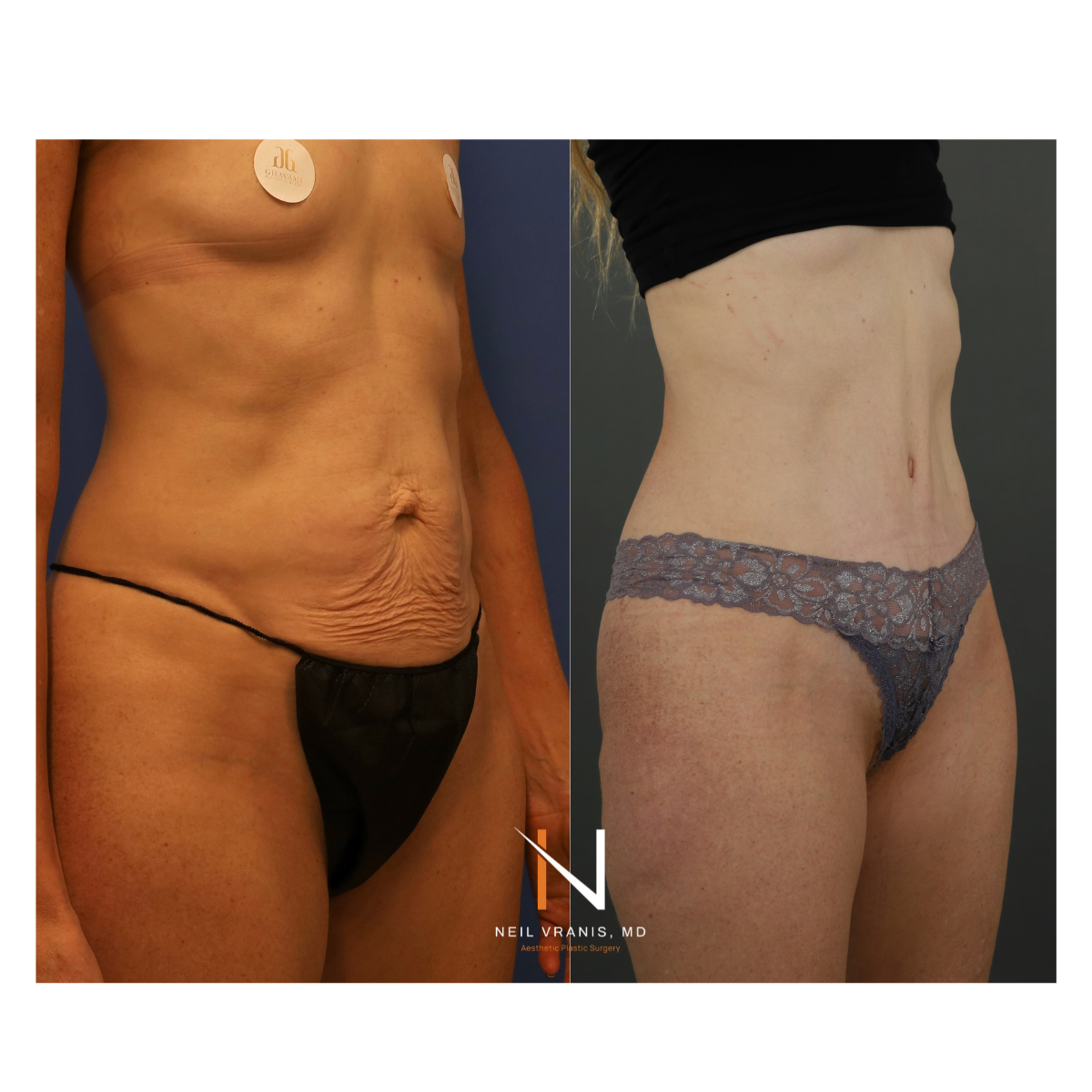 Dr. Neil Vranis Mommy Makeover Before and After Picture