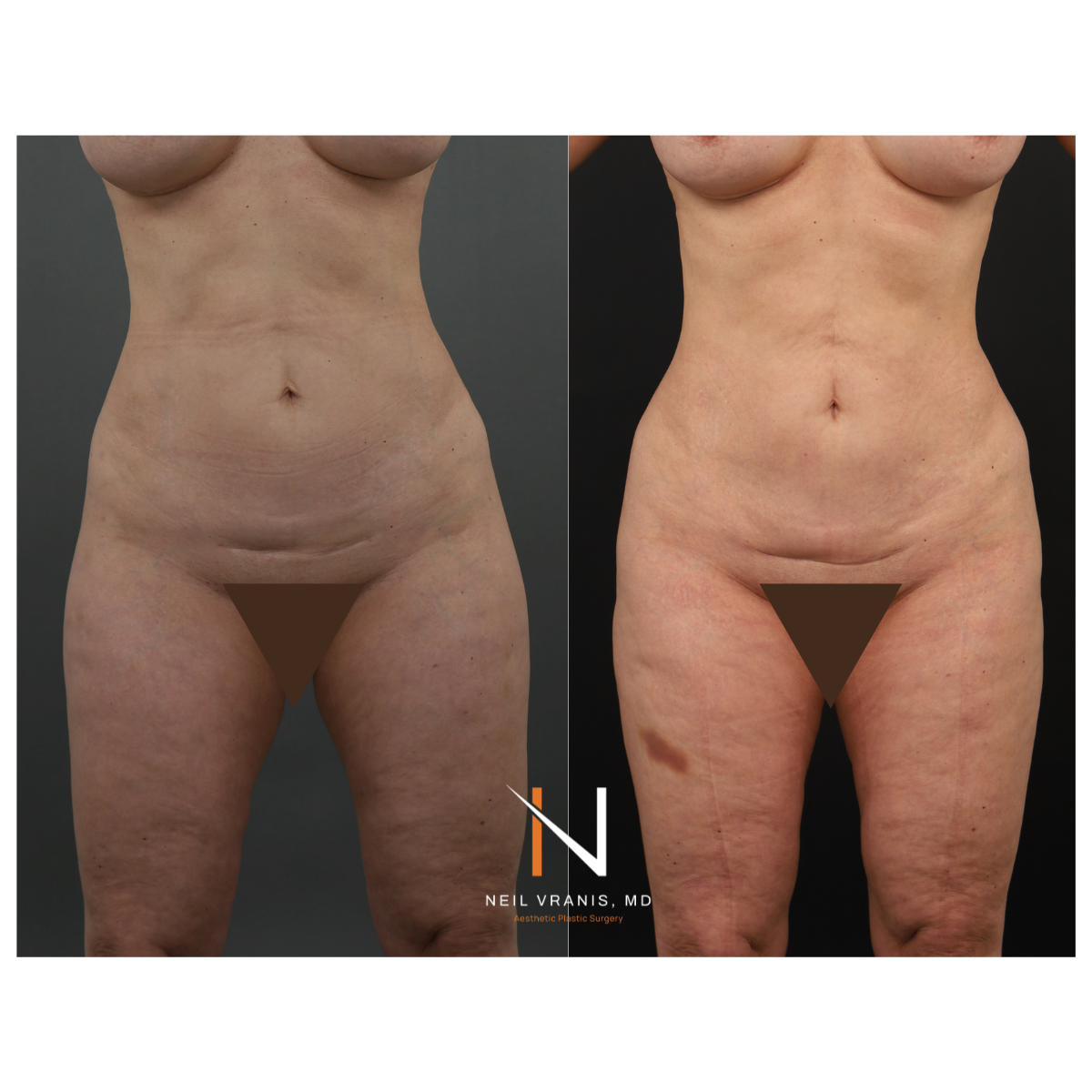 Dr. Neil Vranis Mommy Makeover Before and After Picture