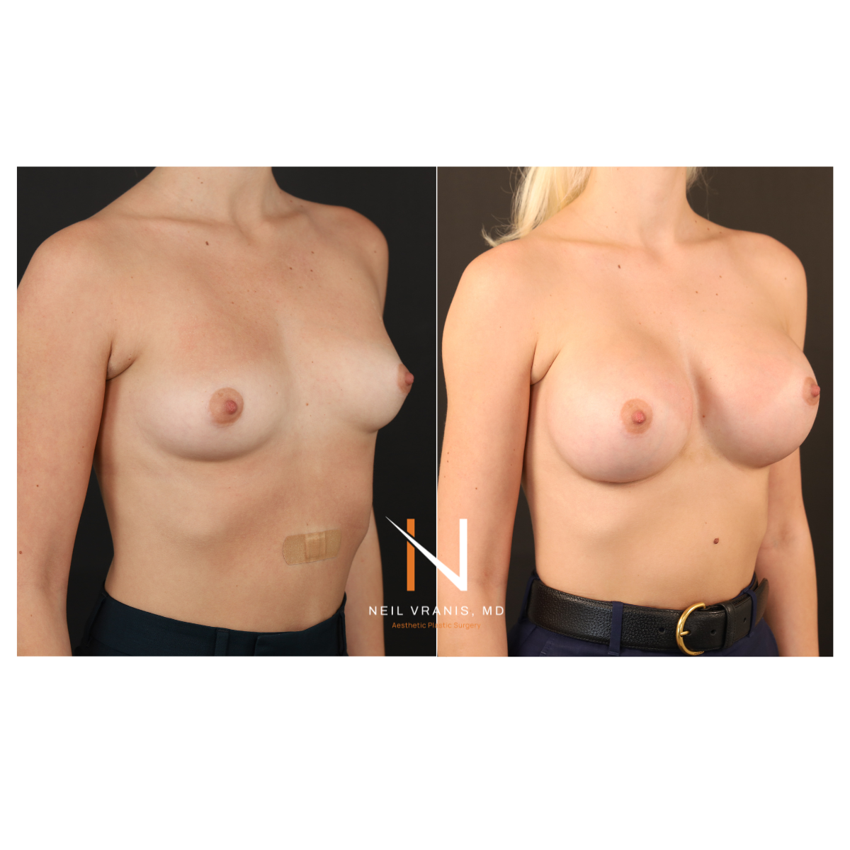 Dr. Neil Vranis Mommy Makeover Before and After Picture
