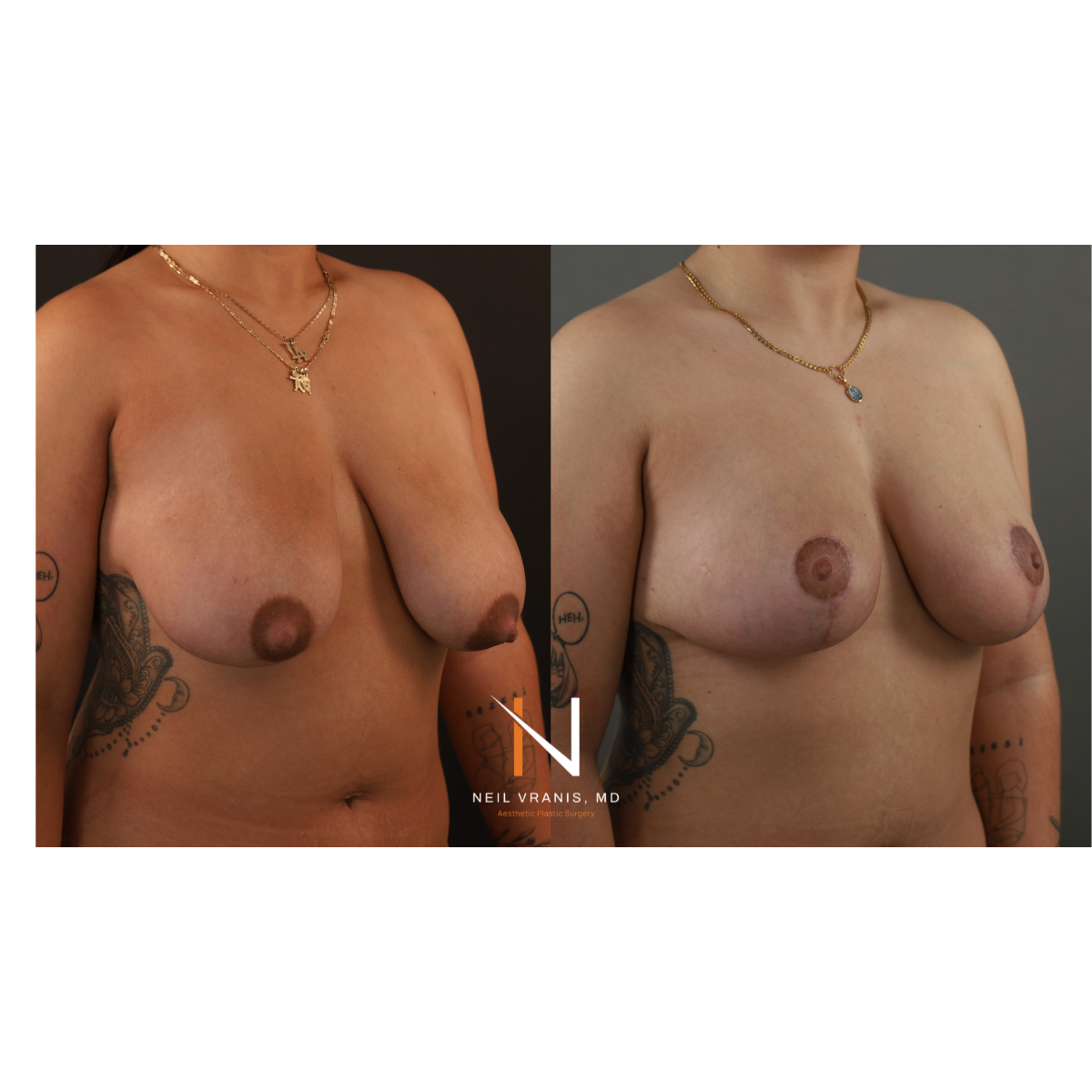 Dr. Neil Vranis Mommy Makeover Before and After Picture