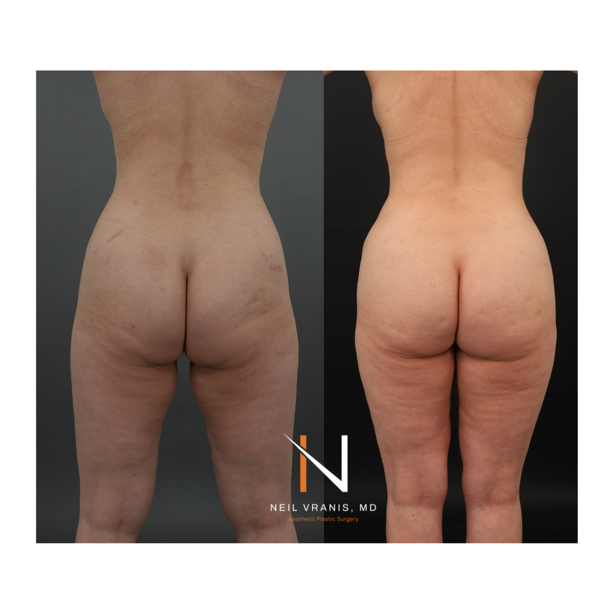 Dr. Neil Vranis Mommy Makeover Before and After Picture