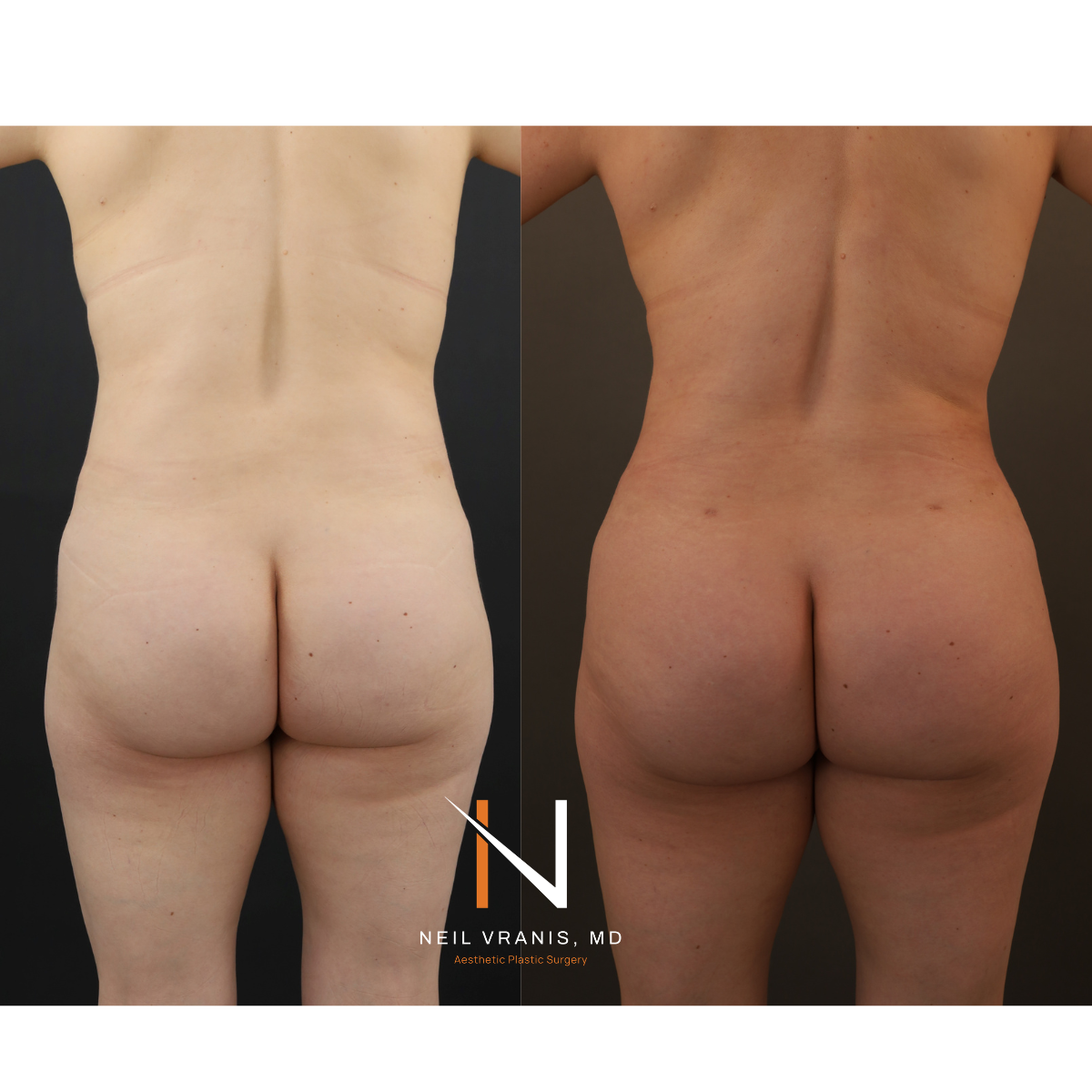 Dr. Neil Vranis Mommy Makeover Before and After Picture
