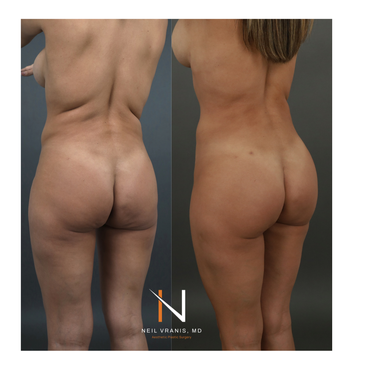 Dr. Neil Vranis Mommy Makeover Before and After Picture