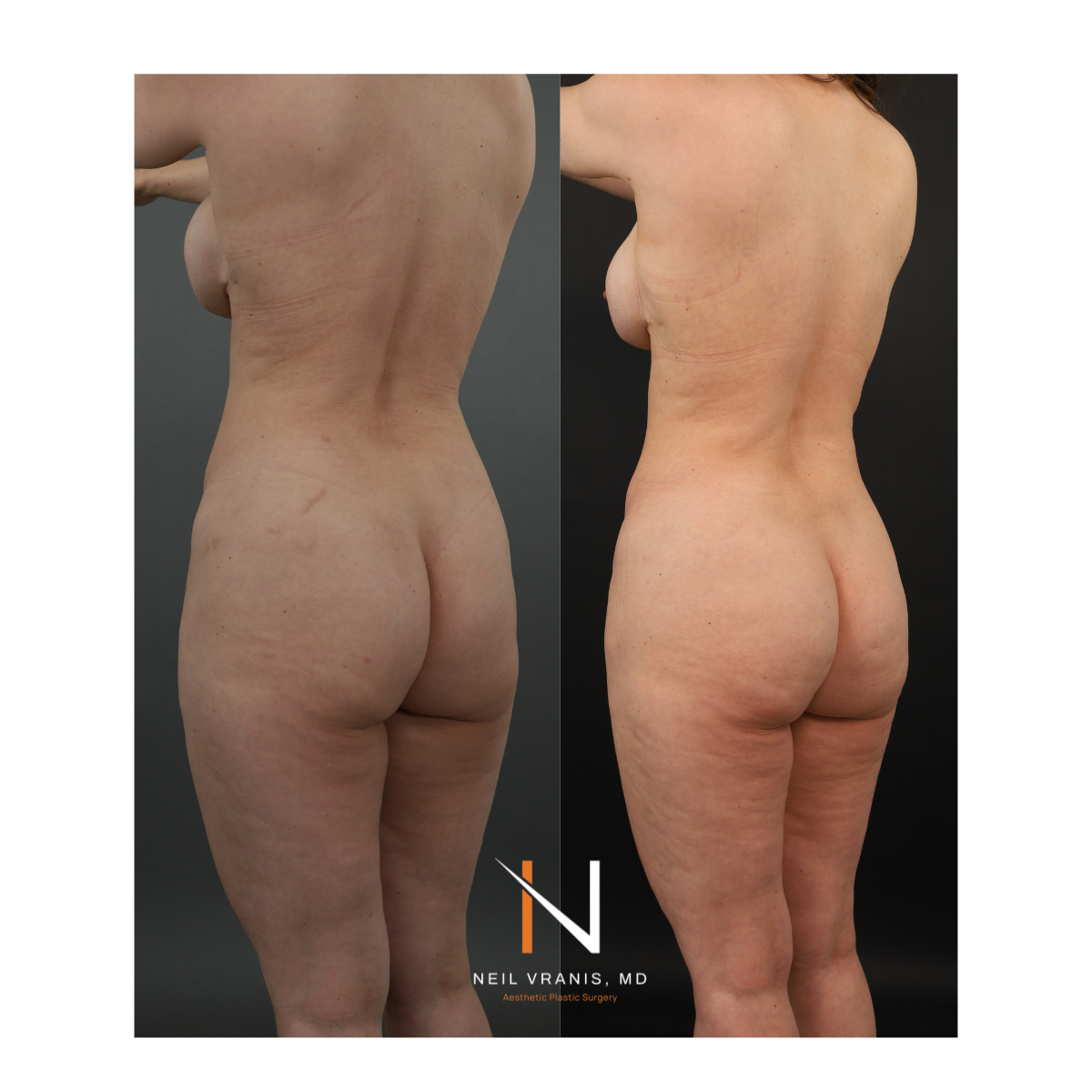 Dr. Neil Vranis Mommy Makeover Before and After Picture