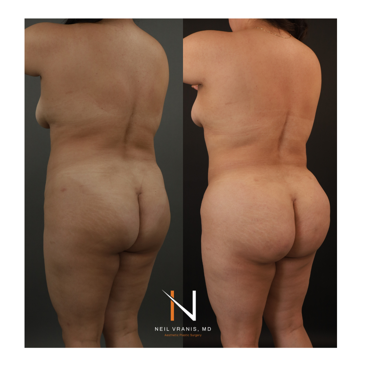 Dr. Neil Vranis Mommy Makeover Before and After Picture