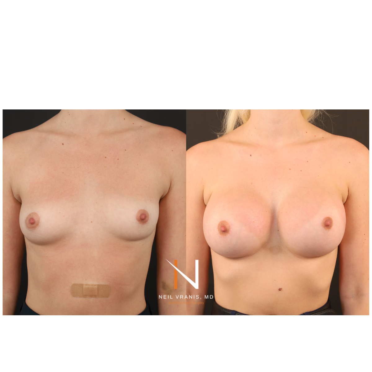 Dr. Neil Vranis Mommy Makeover Before and After Picture