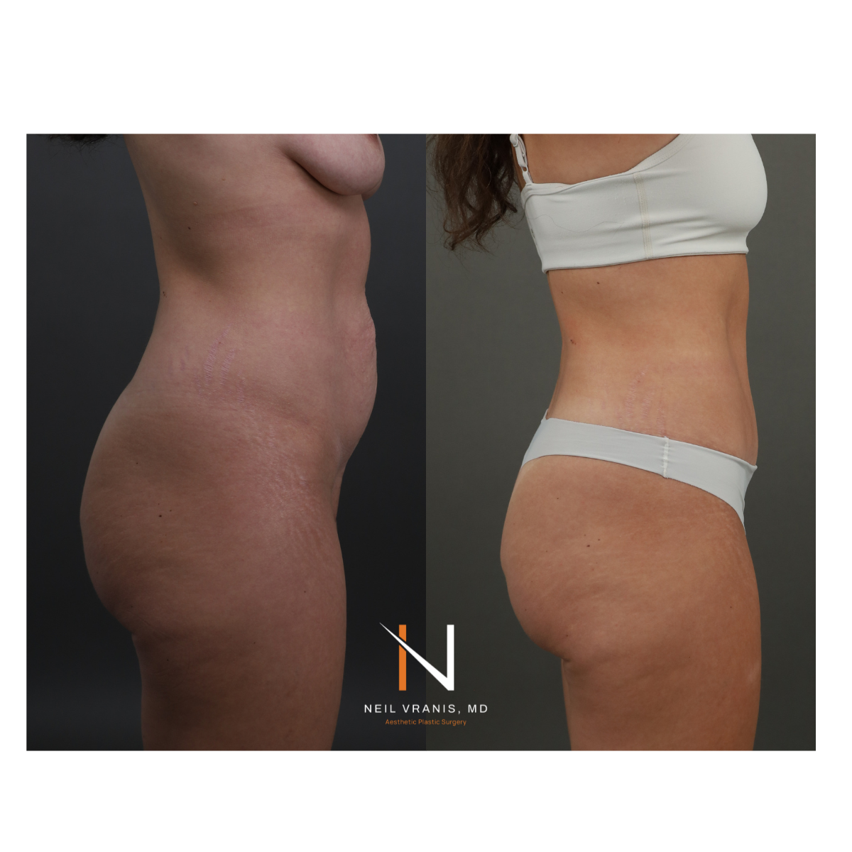Dr. Neil Vranis Mommy Makeover Before and After Picture